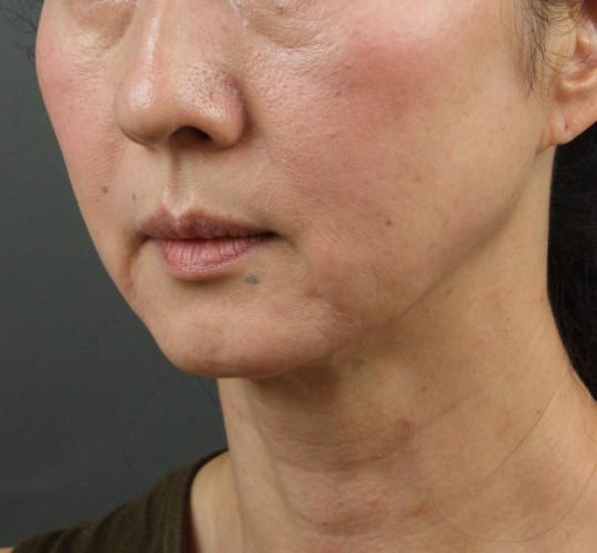 50代女性のVOVリフトプレミアム Before 症例写真