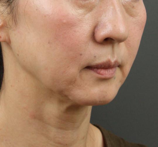 50代女性のVOVリフトプレミアム Before 症例写真