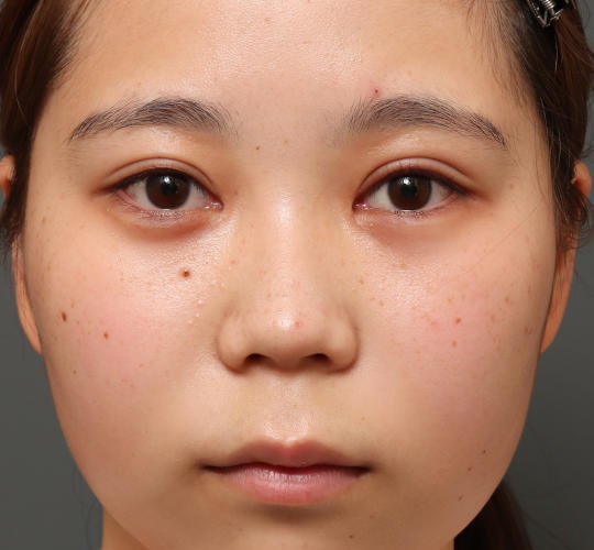 10代女性の目頭切開 After 症例写真