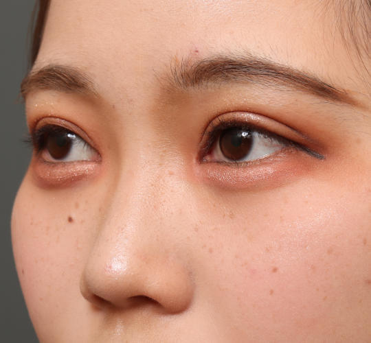 10代女性の全切開二重まぶた法 After 症例写真