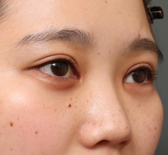 10代女性の全切開二重まぶた法 After 症例写真