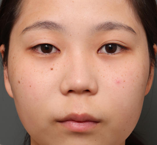 10代女性の目頭切開 Before 症例写真