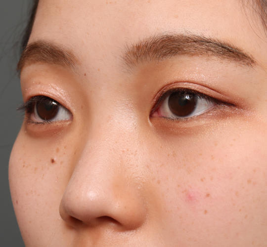 10代女性の全切開二重まぶた法 Before 症例写真