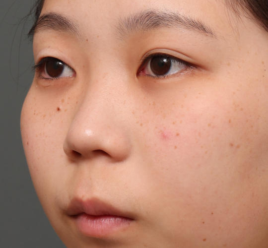 10代女性の全切開二重まぶた法 Before 症例写真