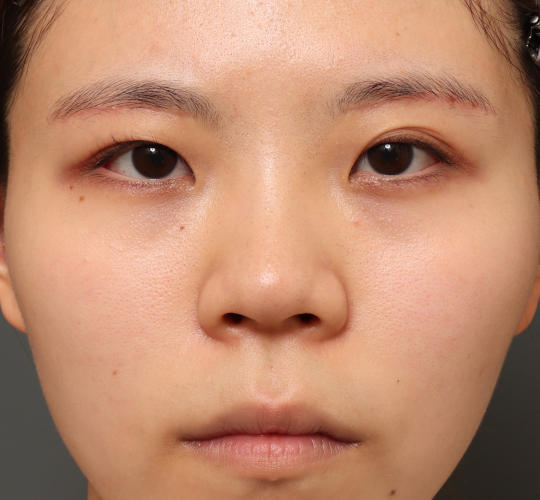 20代女性の眉下切開法 After 症例写真