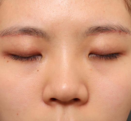 20代女性の眉下切開法 After 症例写真