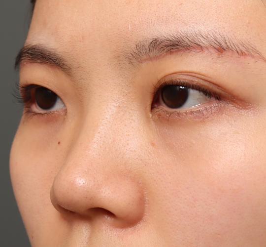 20代女性の眉下切開法 After 症例写真