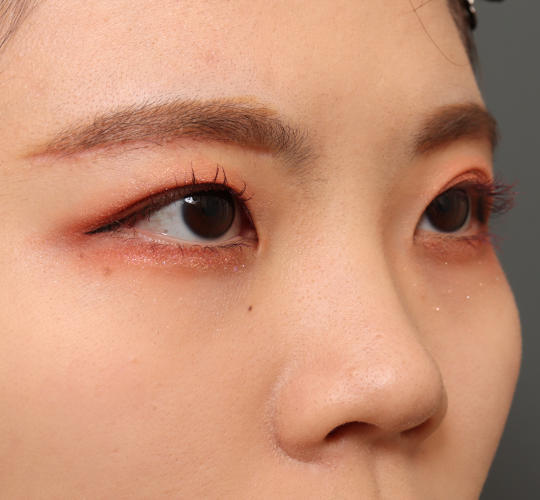 20代女性の眉下切開法 After 症例写真