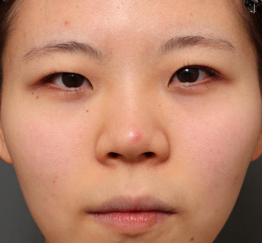 20代女性の眉下切開法 Before 症例写真