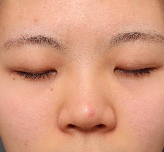 20代女性の眉下切開法 Before 症例写真