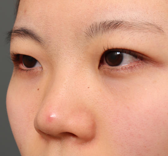 20代女性の眉下切開法 Before 症例写真