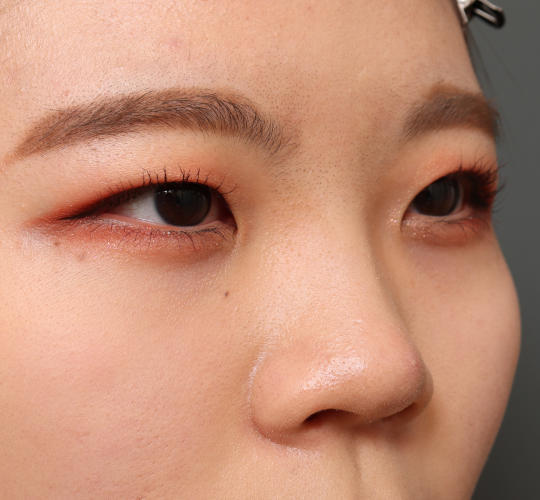 20代女性の眉下切開法 Before 症例写真