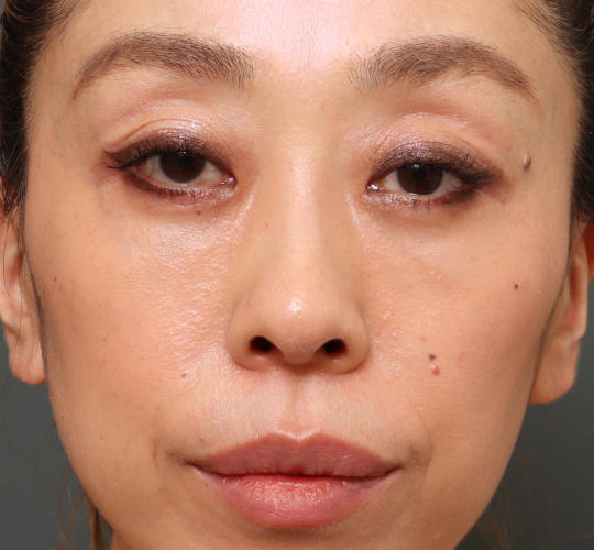 40代女性の3Dリポアイリフト After 症例写真