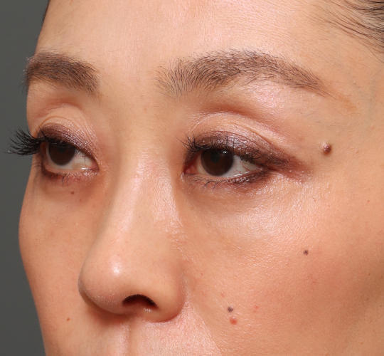 40代女性の3Dリポアイリフト  After 症例写真