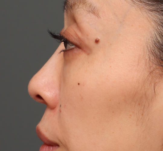 40代女性の3Dリポアイリフト  After 症例写真