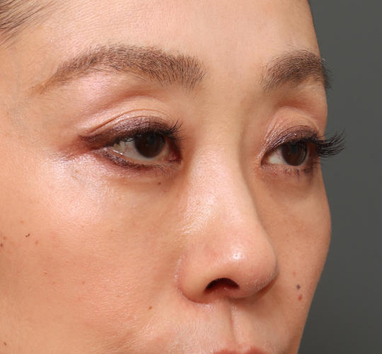 40代女性の3Dリポアイリフト  After 症例写真