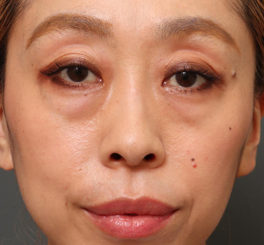 40代女性の3Dリポアイリフト Before 症例写真