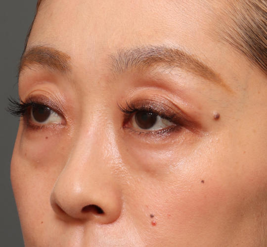 40代女性の3Dリポアイリフト  Before 症例写真