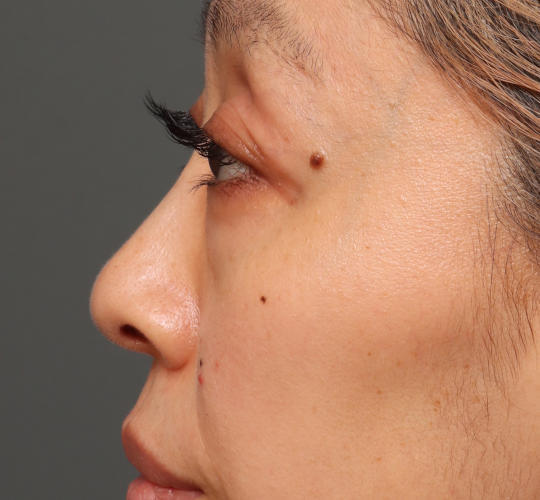 40代女性の3Dリポアイリフト  Before 症例写真