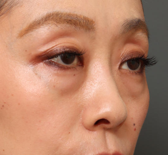 40代女性の3Dリポアイリフト  Before 症例写真