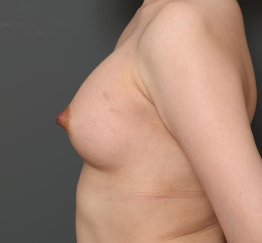 30代女性の豊胸バッグMotiva（モティバ） エルゴノミックス After 症例写真