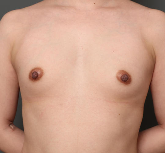 30代女性の豊胸バッグMotiva（モティバ） エルゴノミックス Before 症例写真