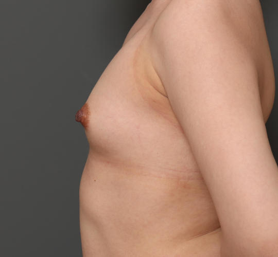 30代女性の豊胸バッグMotiva（モティバ） エルゴノミックス Before 症例写真