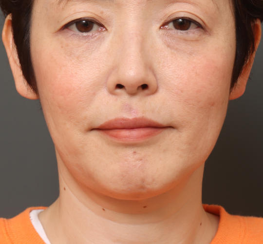 40代女性の顔の脂肪吸引  After 症例写真