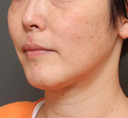 40代女性の顔の脂肪吸引  After 症例写真