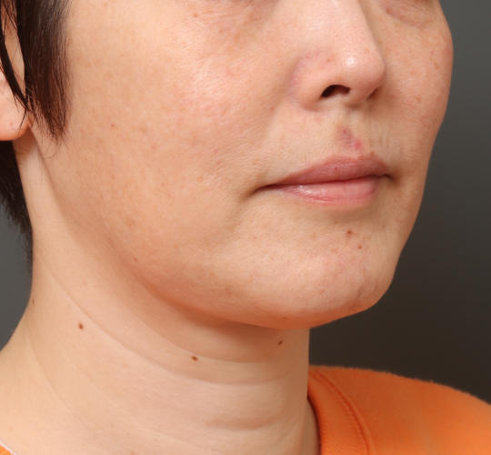40代女性の顔の脂肪吸引  After 症例写真