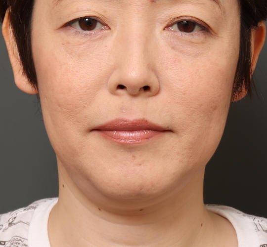 40代女性の顔の脂肪吸引  Before 症例写真