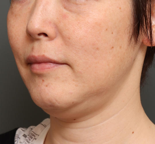 40代女性の顔の脂肪吸引  Before 症例写真