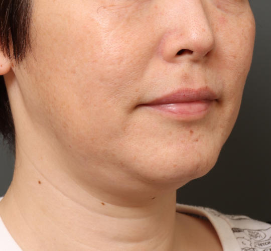 40代女性の顔の脂肪吸引  Before 症例写真