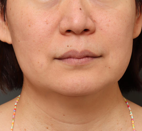 50代女性のボトックス（小顔） After 症例写真