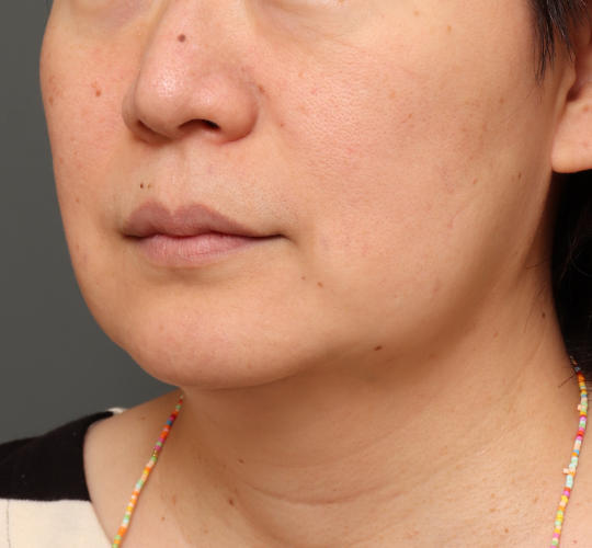 50代女性のボトックス（小顔） After 症例写真