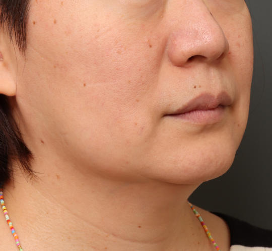 50代女性のボトックス(小顔) After 症例写真