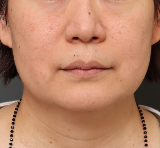 50代女性のボトックス（小顔） Before 症例写真