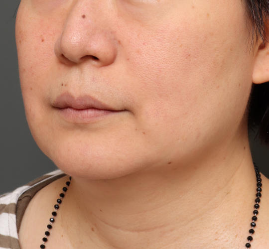 50代女性のボトックス（小顔） Before 症例写真