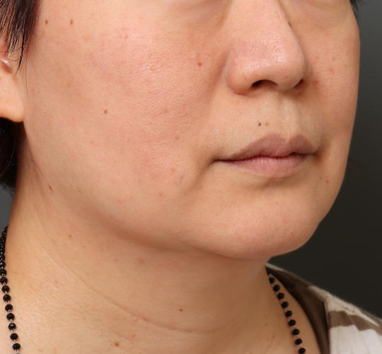 50代女性のボトックス(小顔) Before 症例写真