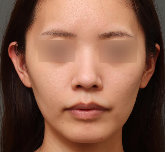 30代女性のシミ・そばかす After 症例写真