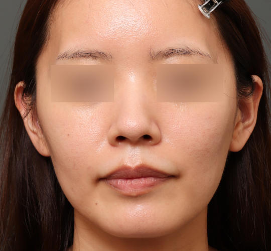 30代女性のシミ・そばかす Before 症例写真