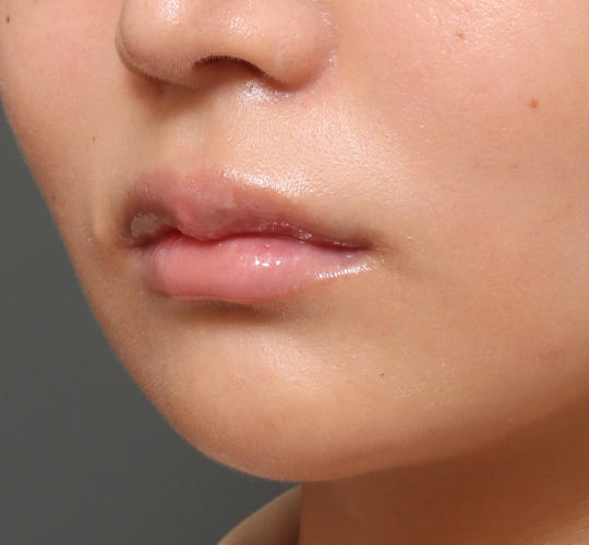 20代女性の人中短縮ボトックス After 症例写真