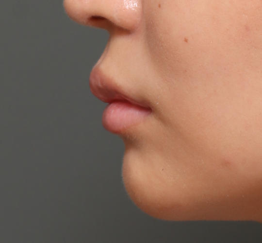 20代女性の人中短縮ボトックス After 症例写真