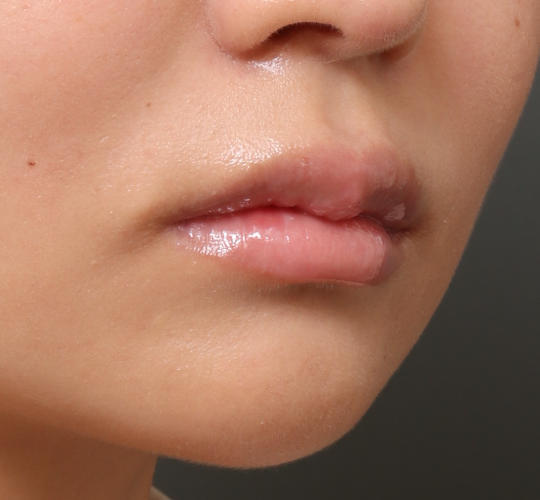 20代女性の人中短縮ボトックス After 症例写真