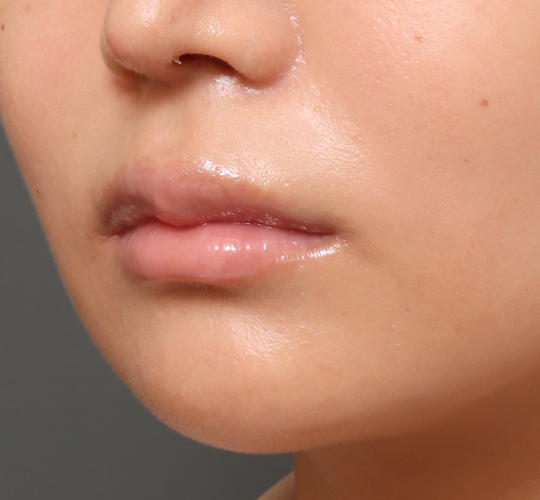 20代女性の人中短縮ボトックス Before 症例写真