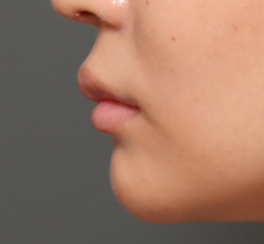 20代女性の人中短縮ボトックス Before 症例写真