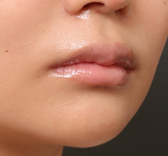 20代女性の人中短縮ボトックス Before 症例写真