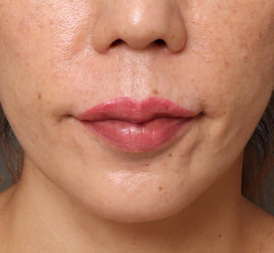 40代女性のヒアルロン酸注射（唇） After 症例写真
