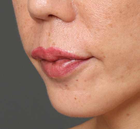 40代女性のヒアルロン酸注射（唇） After 症例写真