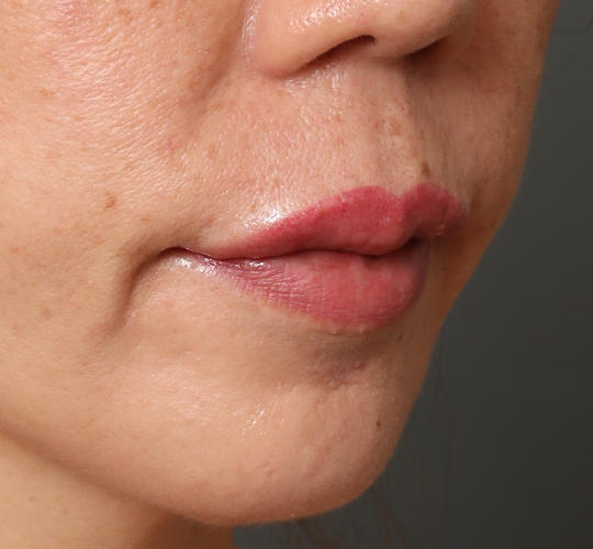 40代女性のヒアルロン酸注射（唇） After 症例写真